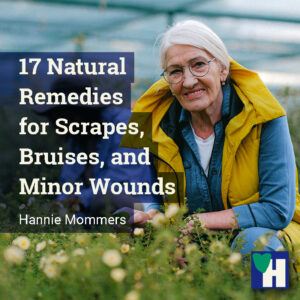 17 Natural Remedies for Scrapes, Bruises, and Minor Wounds